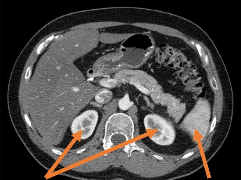 Localization Of Spleen And Kidney Organs From Ct Scans Based On Classification Of Slices In Rotational Views