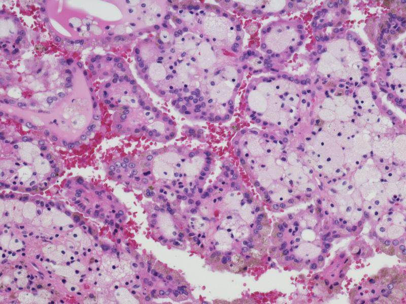 Cancer Cells Classified By Type Using Deep Learning Model