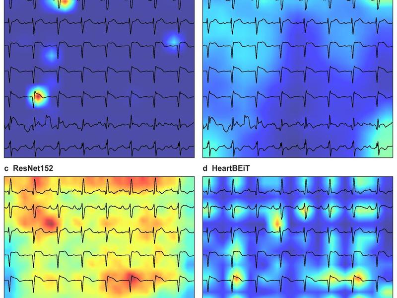 Researchers Use New Deep Learning Approach To Enable Analysis Of Electrocardiograms As Language