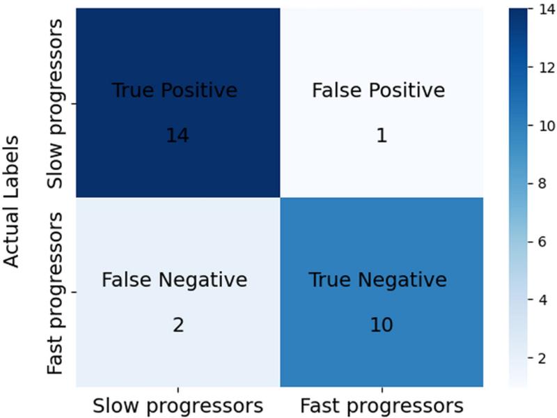 Mri-based Multivariate Gray Matter Volumetric Distance For Predicting Motor Symptom Progression In Parkinson’s Disease