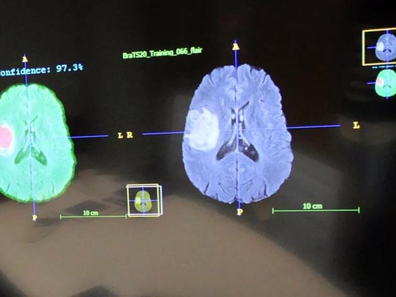 Evaluating Brain Tumours With Artificial Intelligence