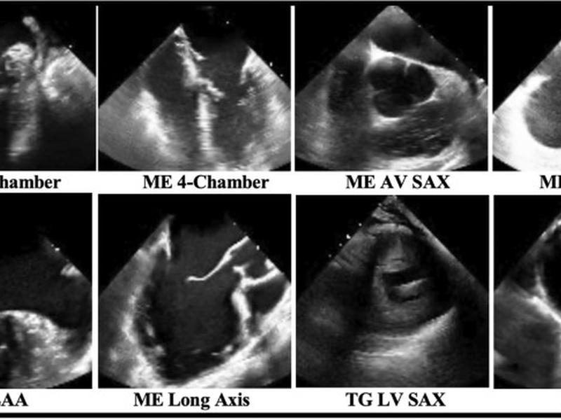 Deep Learning For Transesophageal Echocardiography View Classification