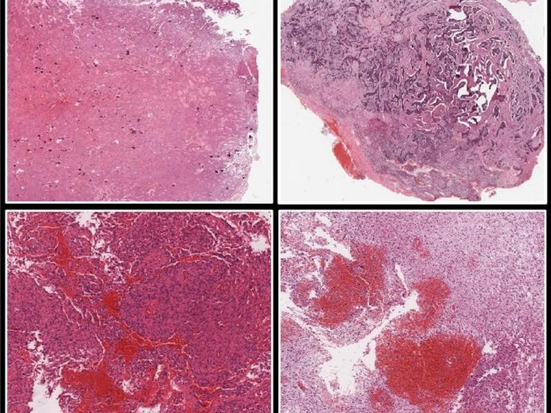 A Multi-class Brain Tumor Grading System Based On Histopathological Images Using A Hybrid Yolo And Resnet Networks