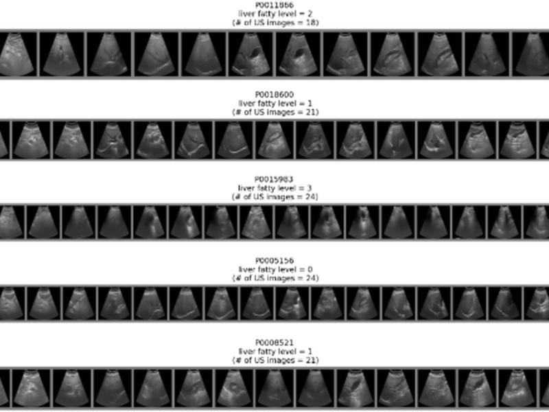 Fatty Liver Classification Via Risk Controlled Neural Networks Trained On Grouped Ultrasound Image Data