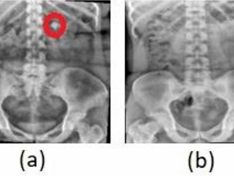 Identification Of Kidney Stones In Kub X-ray Images Using Vgg16 Empowered With Explainable Artificial Intelligence