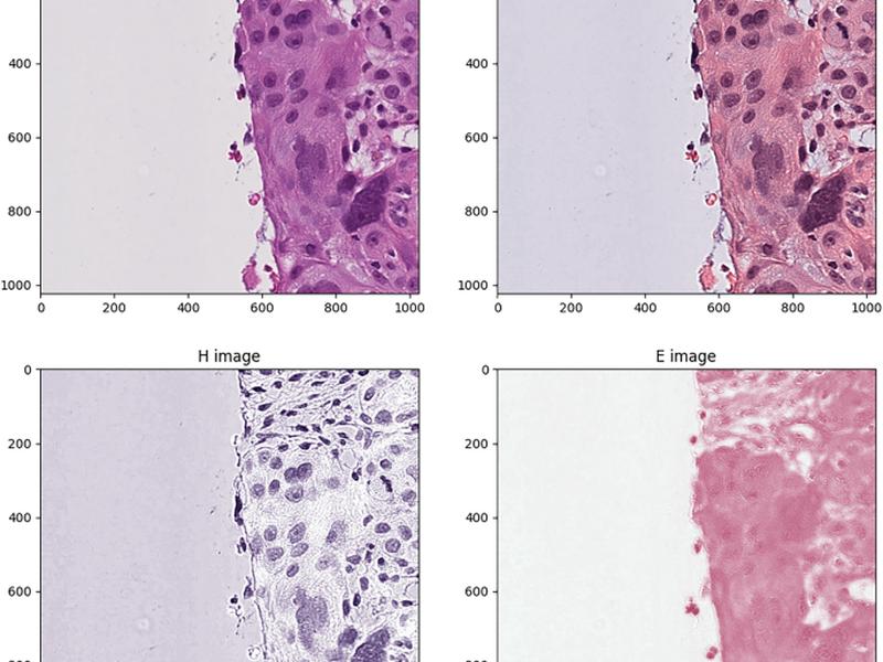 Multimodal Artificial Intelligence-based Pathogenomics Improves Survival Prediction In Oral Squamous Cell Carcinoma
