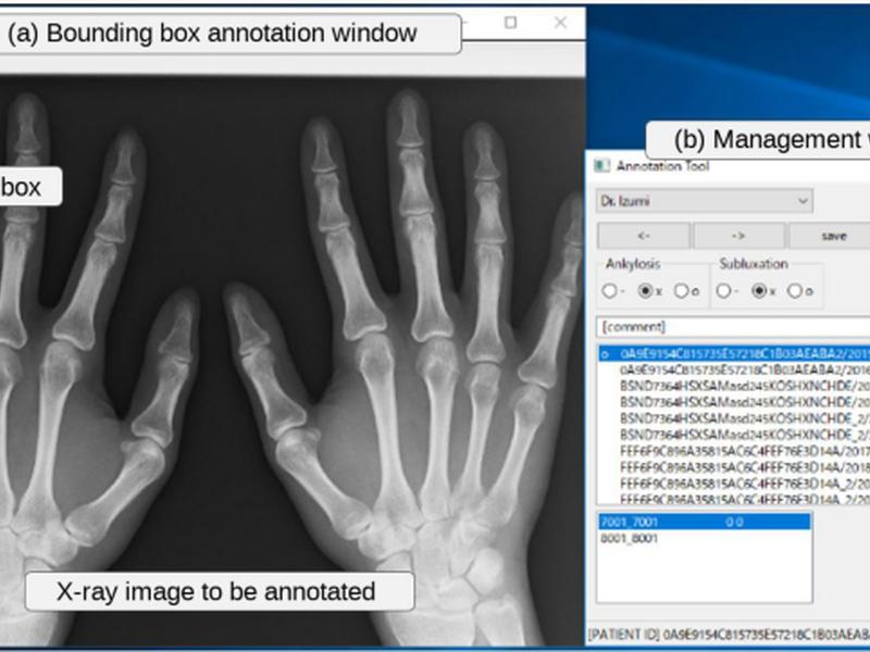 Ensemble Detection Of Hand Joint Ankylosis And Subluxation In Radiographic Images Using Deep Neural Networks