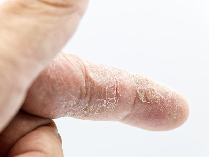 Machine Learning Model Identifies Hidden Cases Of Hidradenitis Suppurativa