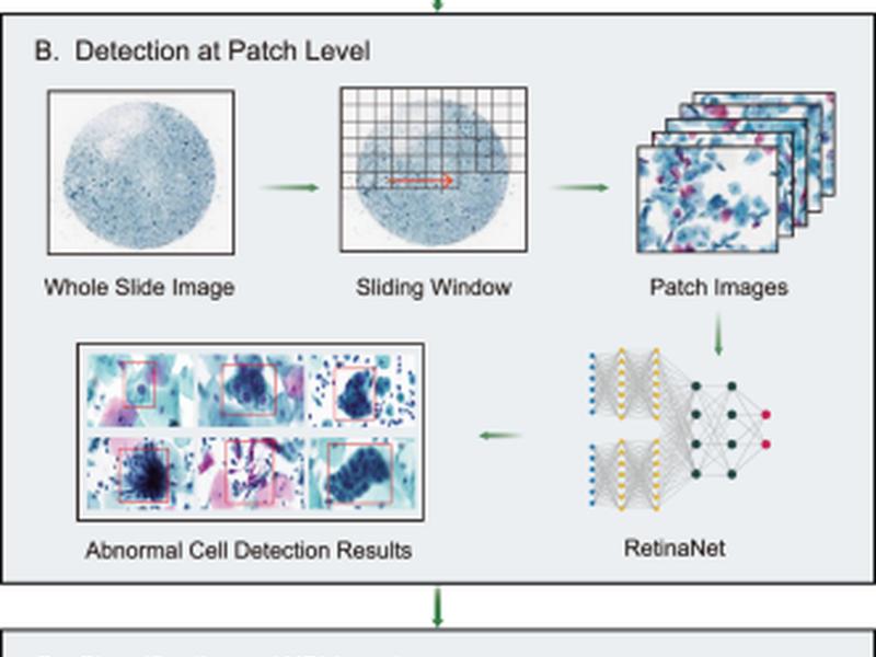 Artificial Intelligence Enables Precision Diagnosis Of Cervical Cytology Grades And Cervical Cancer