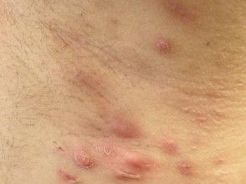 Hidradenitis Suppurativa Diagnosis May Be Predicted And Supported By Machine Learning Model