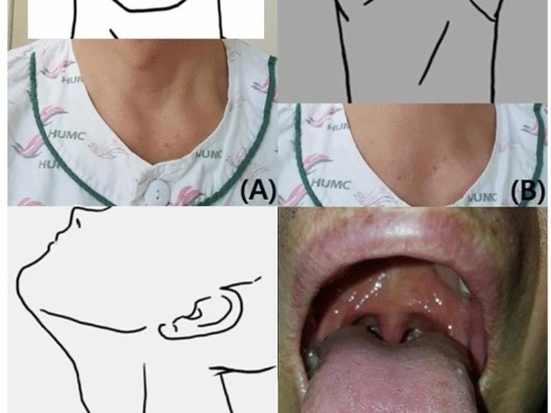 Improving Difficult Direct Laryngoscopy Prediction Using Deep Learning And Minimal Image Analysis: A Single-center Prospective Study