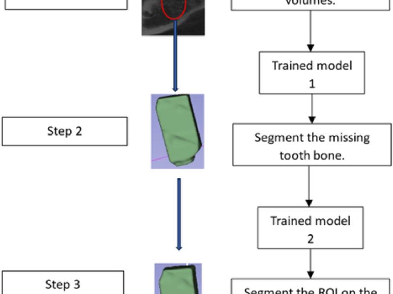 Deep Learning-based Approach For 3d Bone Segmentation And Prediction Of Missing Tooth Region For Dental Implant Planning