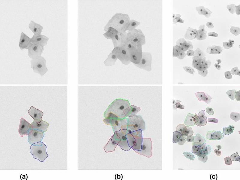 An Improved Approach For Automated Cervical Cell Segmentation With Pointrend