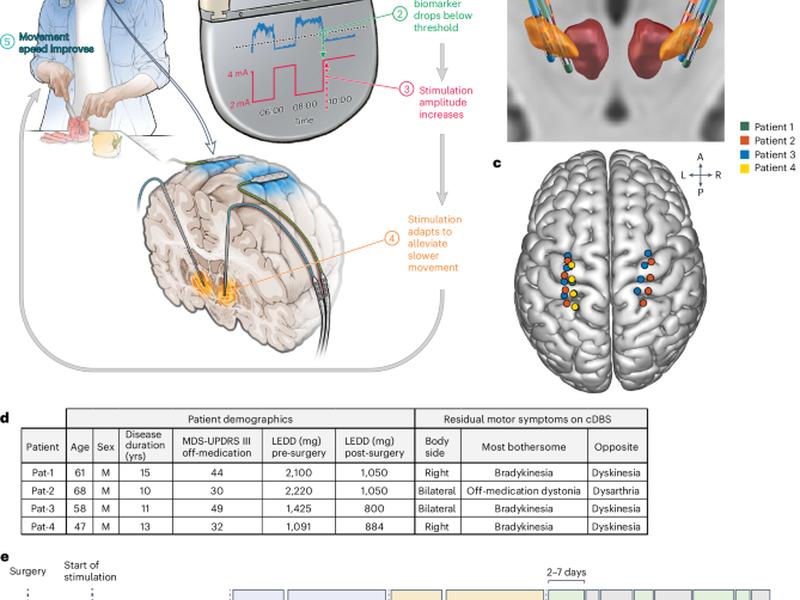 Chronic Adaptive Deep Brain Stimulation Versus Conventional Stimulation In Parkinson’s Disease: A Blinded Randomized Feasibility Trial